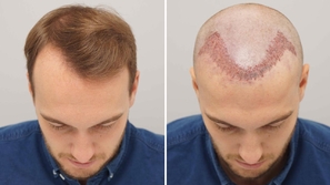 زراعة الشعر للرجال: كل ما تود معرفته بالتفصيل