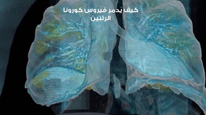كيف يُدمر فيروس كورونا الرئتين؟